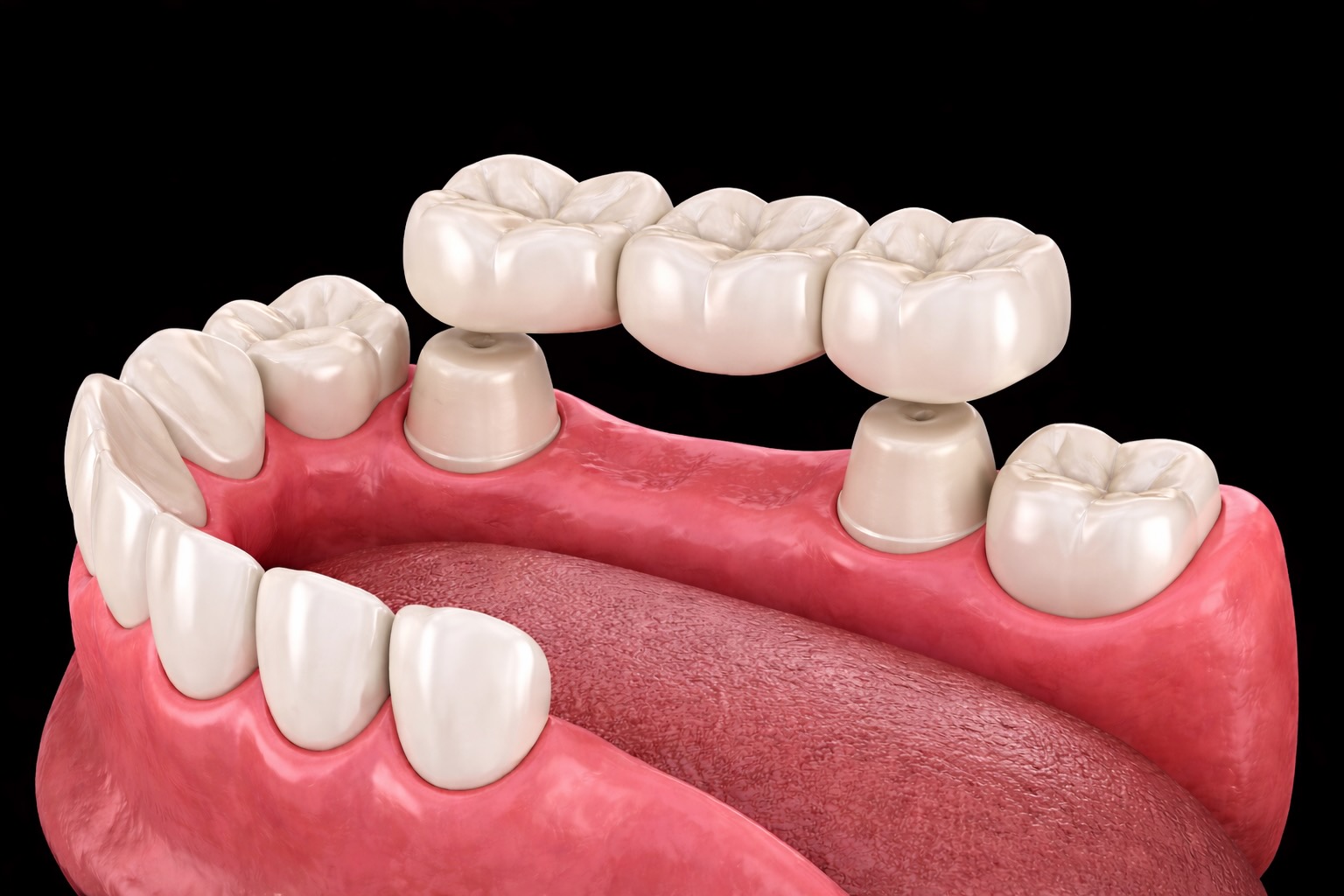 Zahnbrücken im Zahnlabor De Fazio