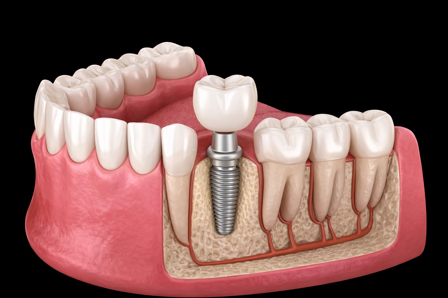 Implantatprothetik im Zahnlabor
