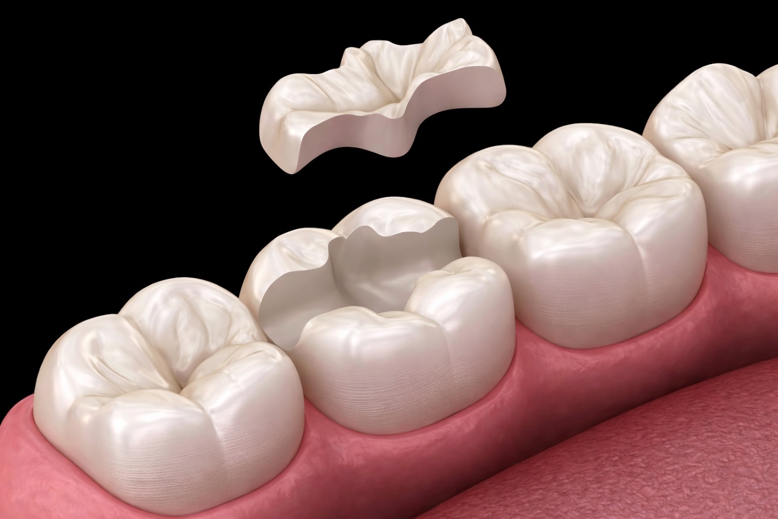 Keramikinlay im Zahnlabor De Fazio