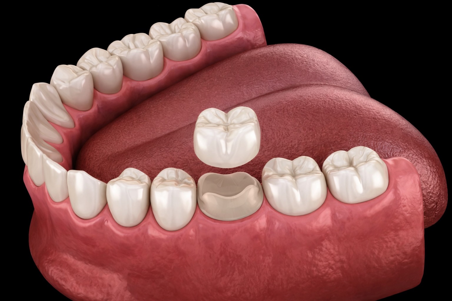 Zahnkronen im Zahnlabor De Fazio